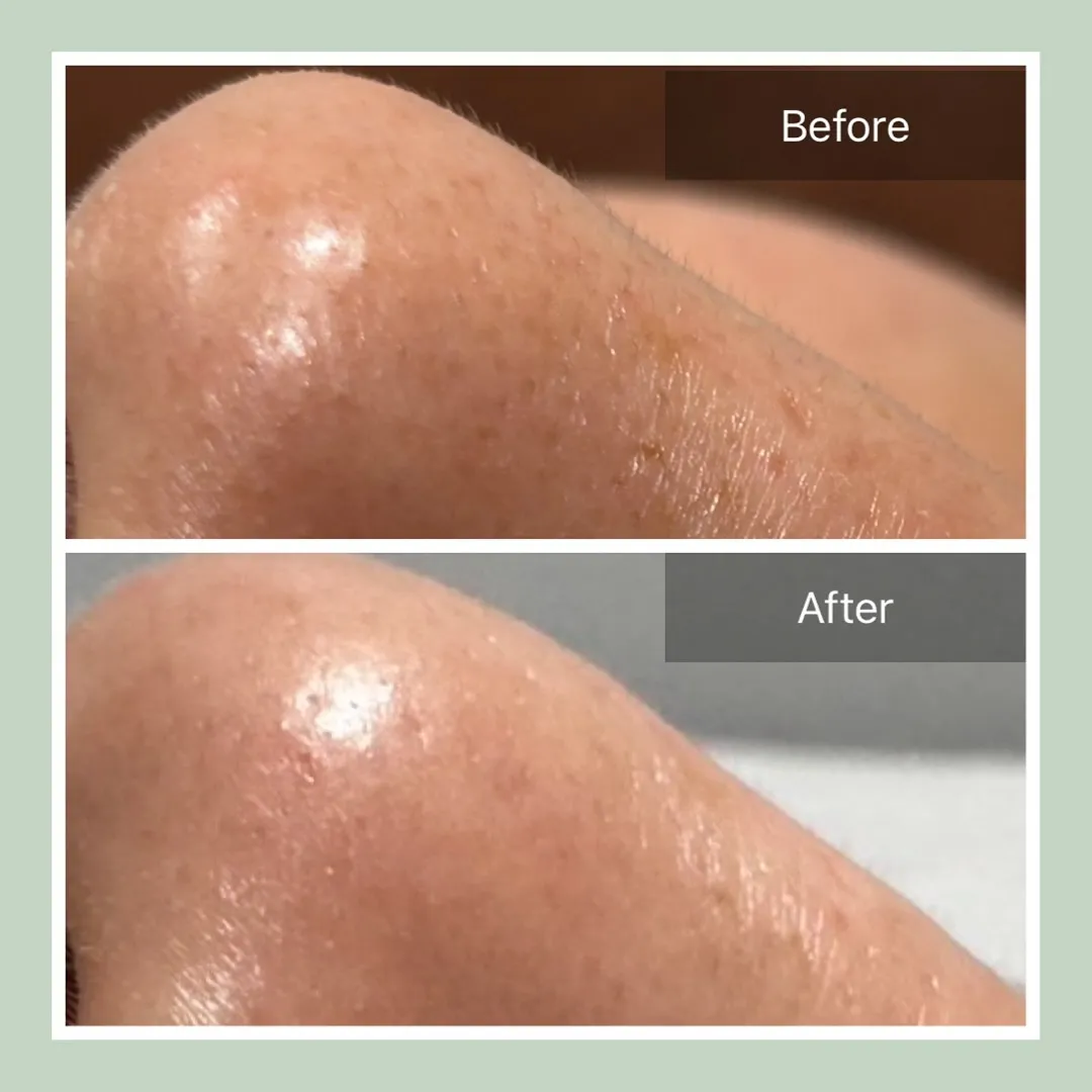 💎気になる小鼻の汚れ