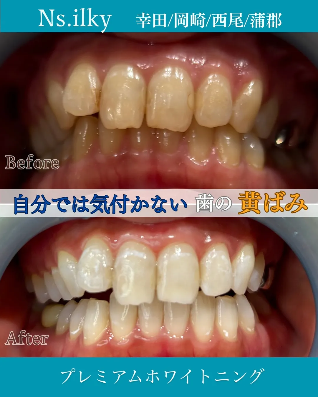 💎歯の色気になってませんか？