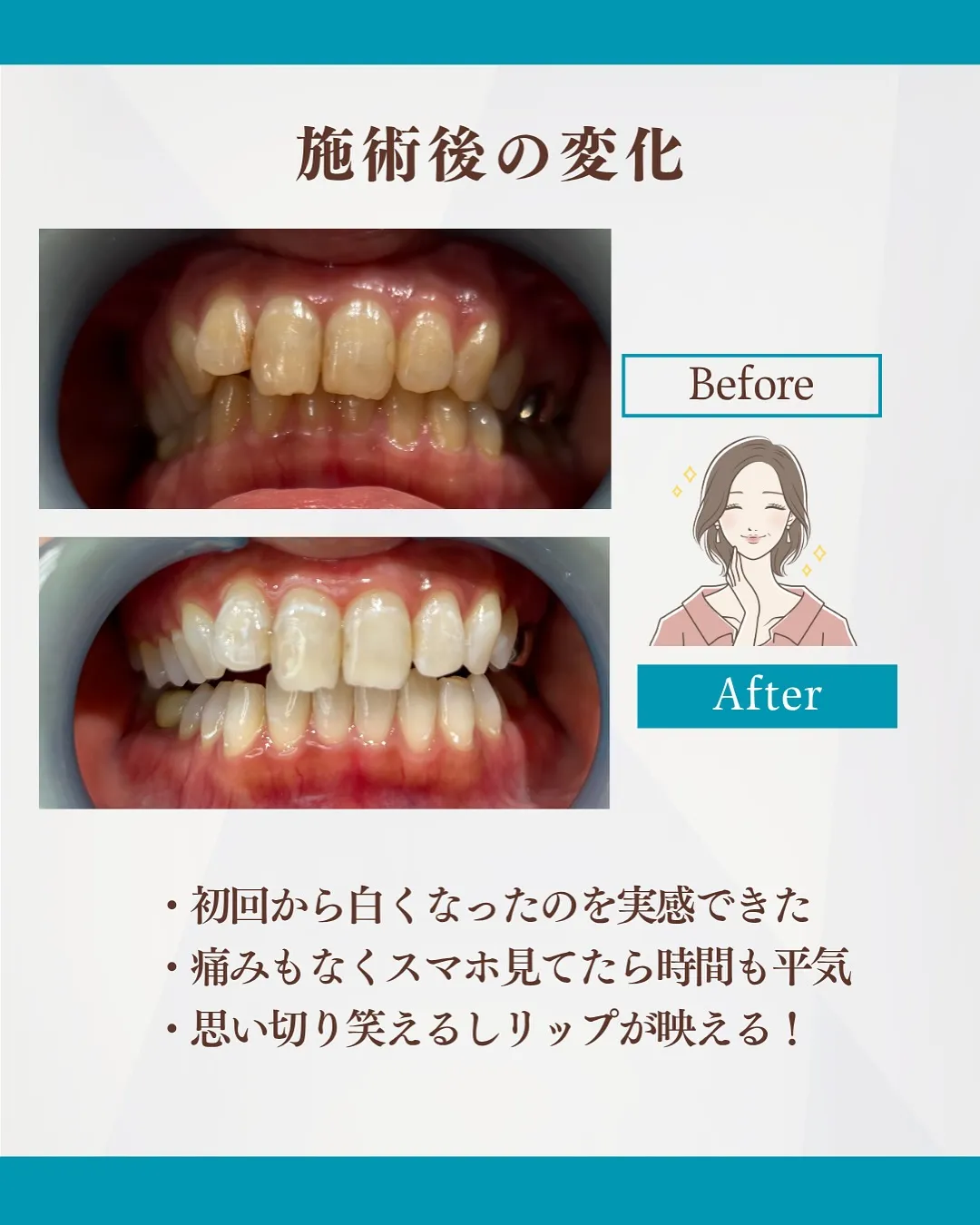 💎歯の色気になってませんか?