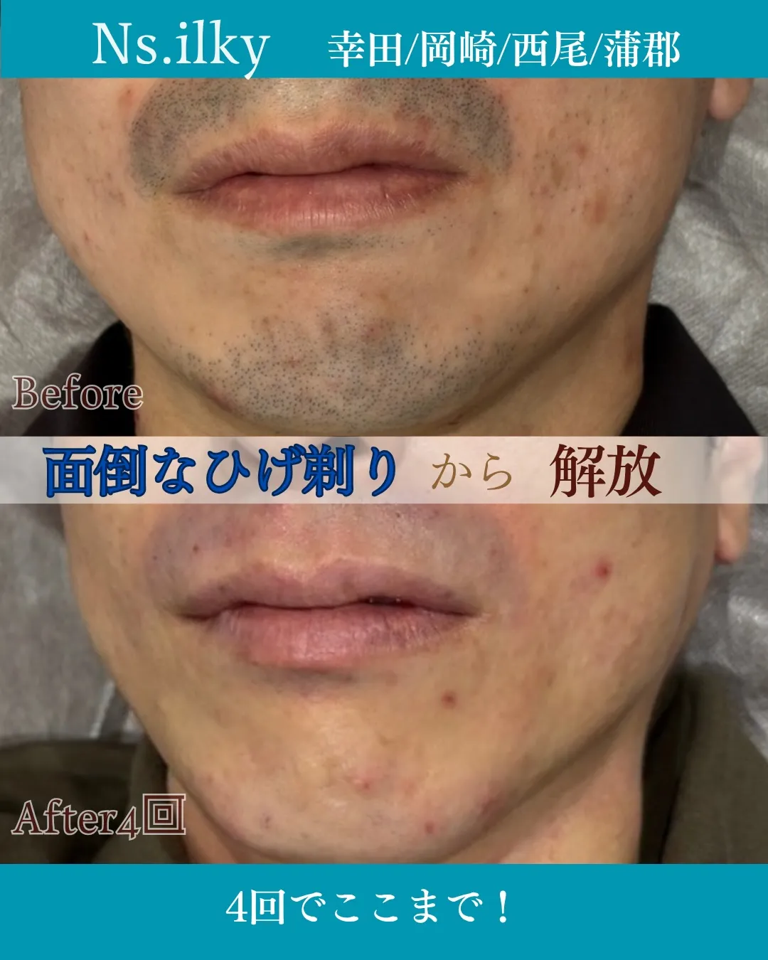 💎ヒゲ脱毛すると