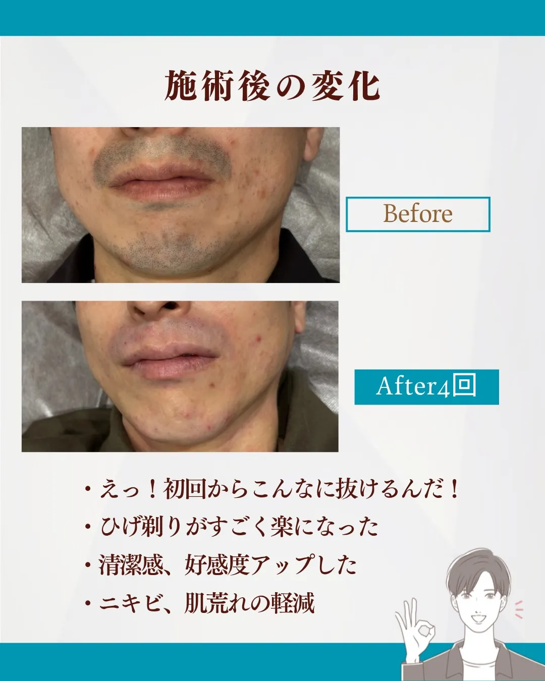 💎ヒゲ脱毛すると